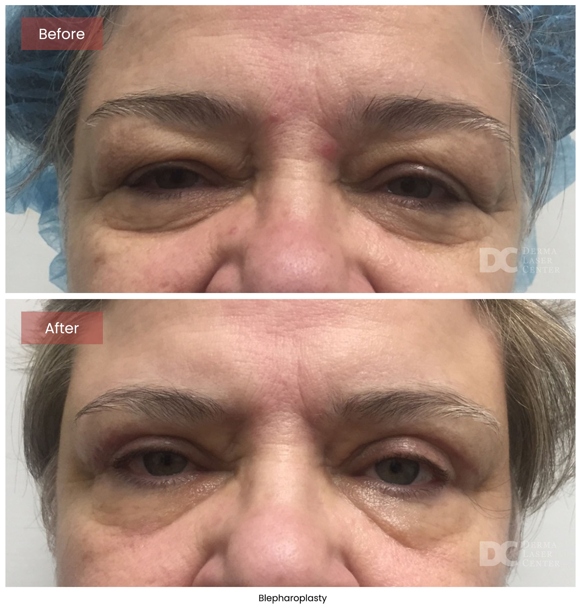 Blepharoplasty 10