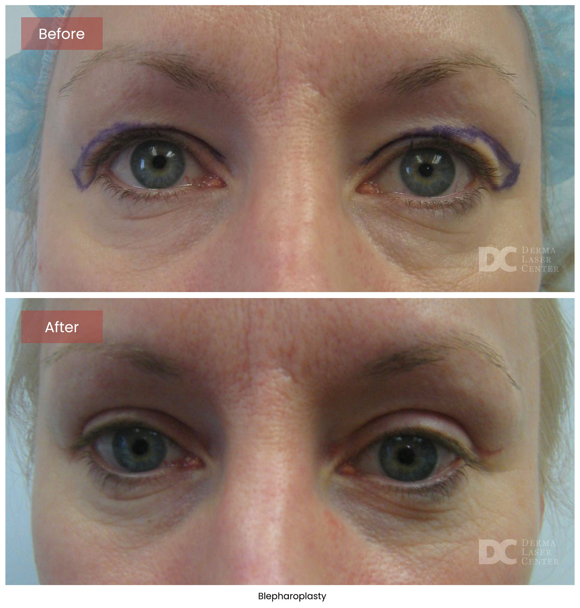 Blepharoplasty 2
