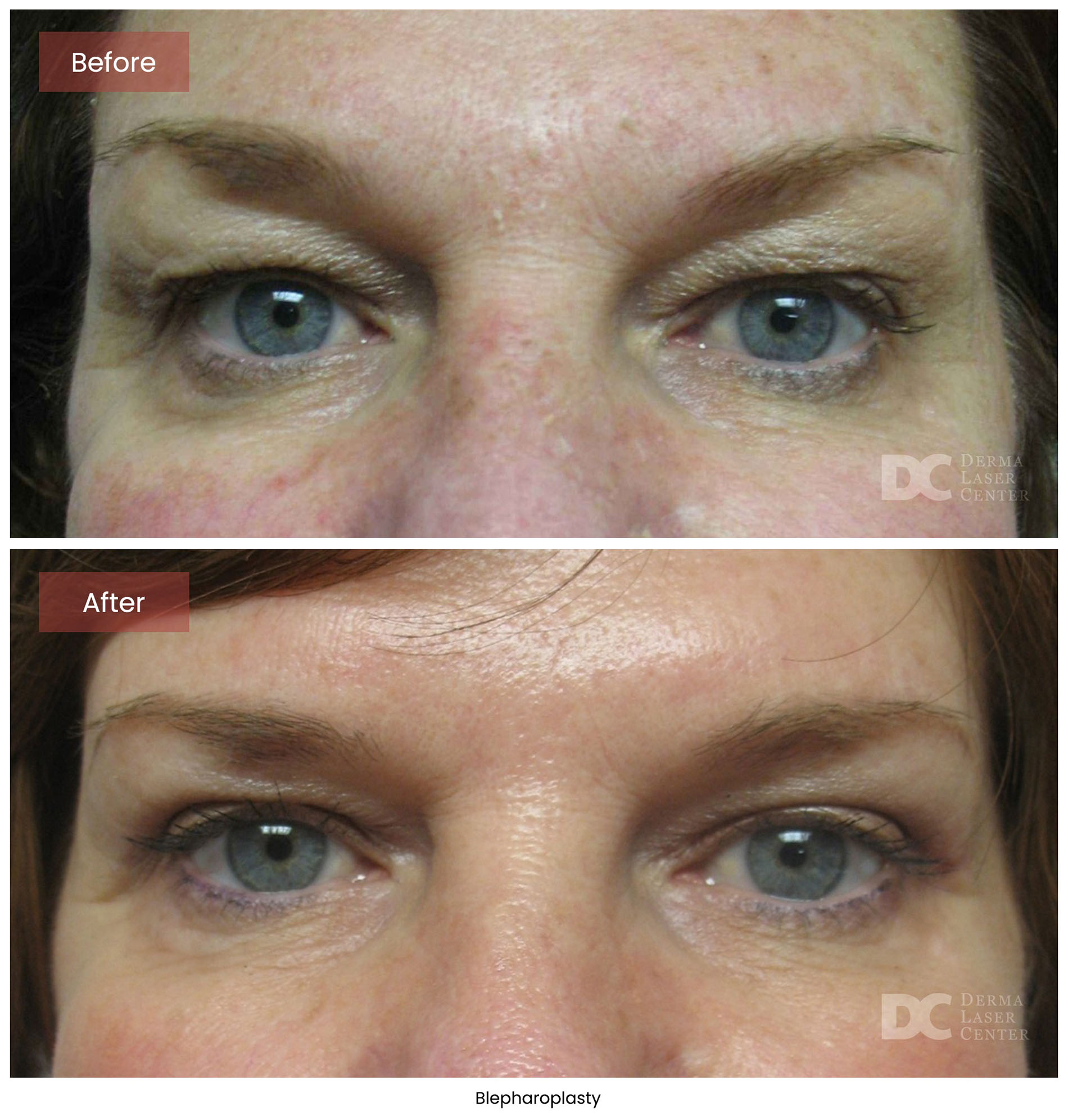 Blepharoplasty 3