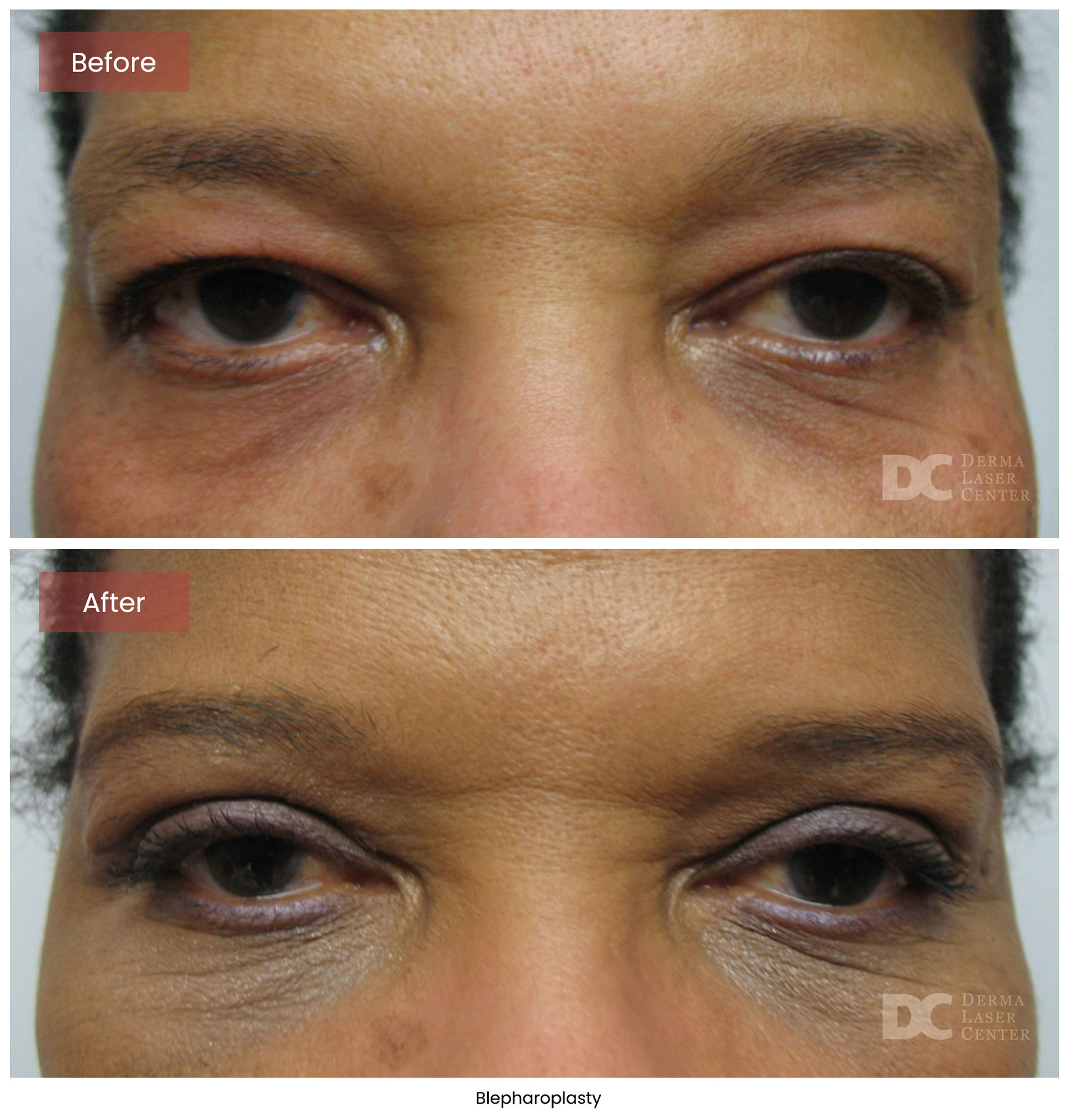 Blepharoplasty 4