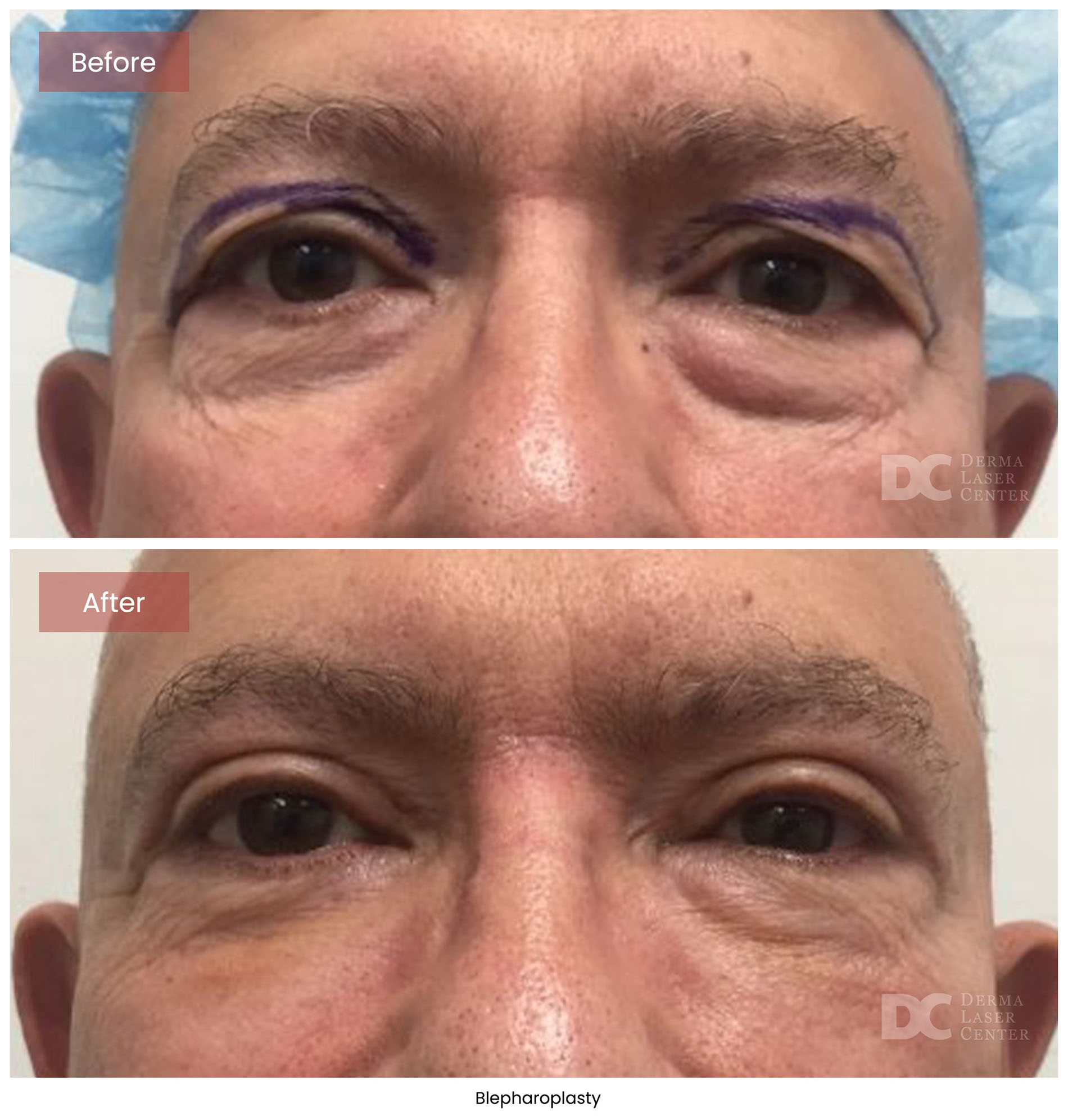 Blepharoplasty 5