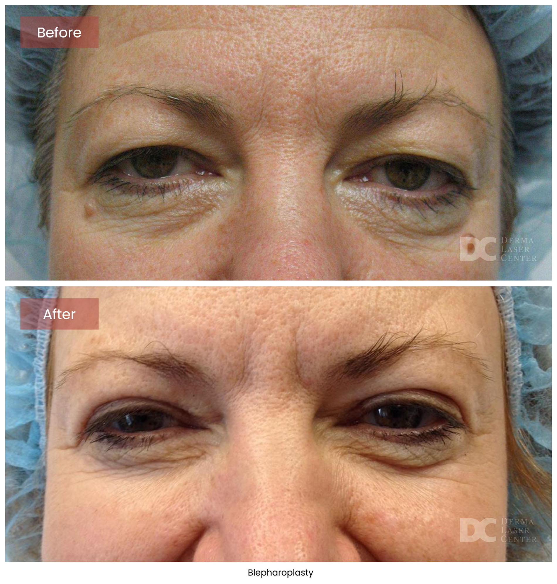 Blepharoplasty 6