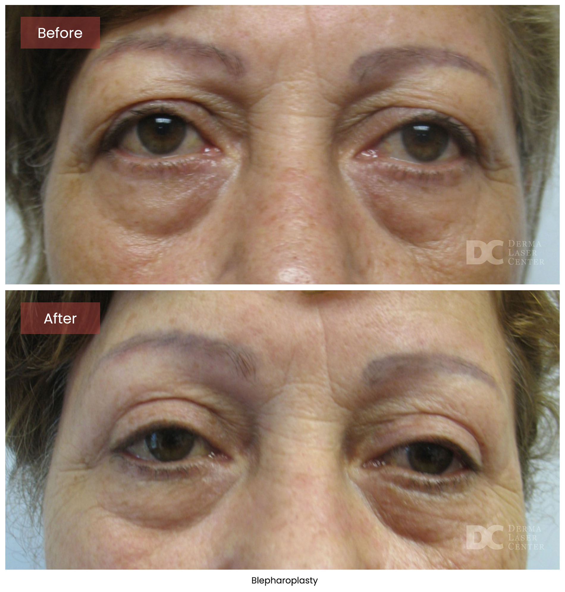 Blepharoplasty 7