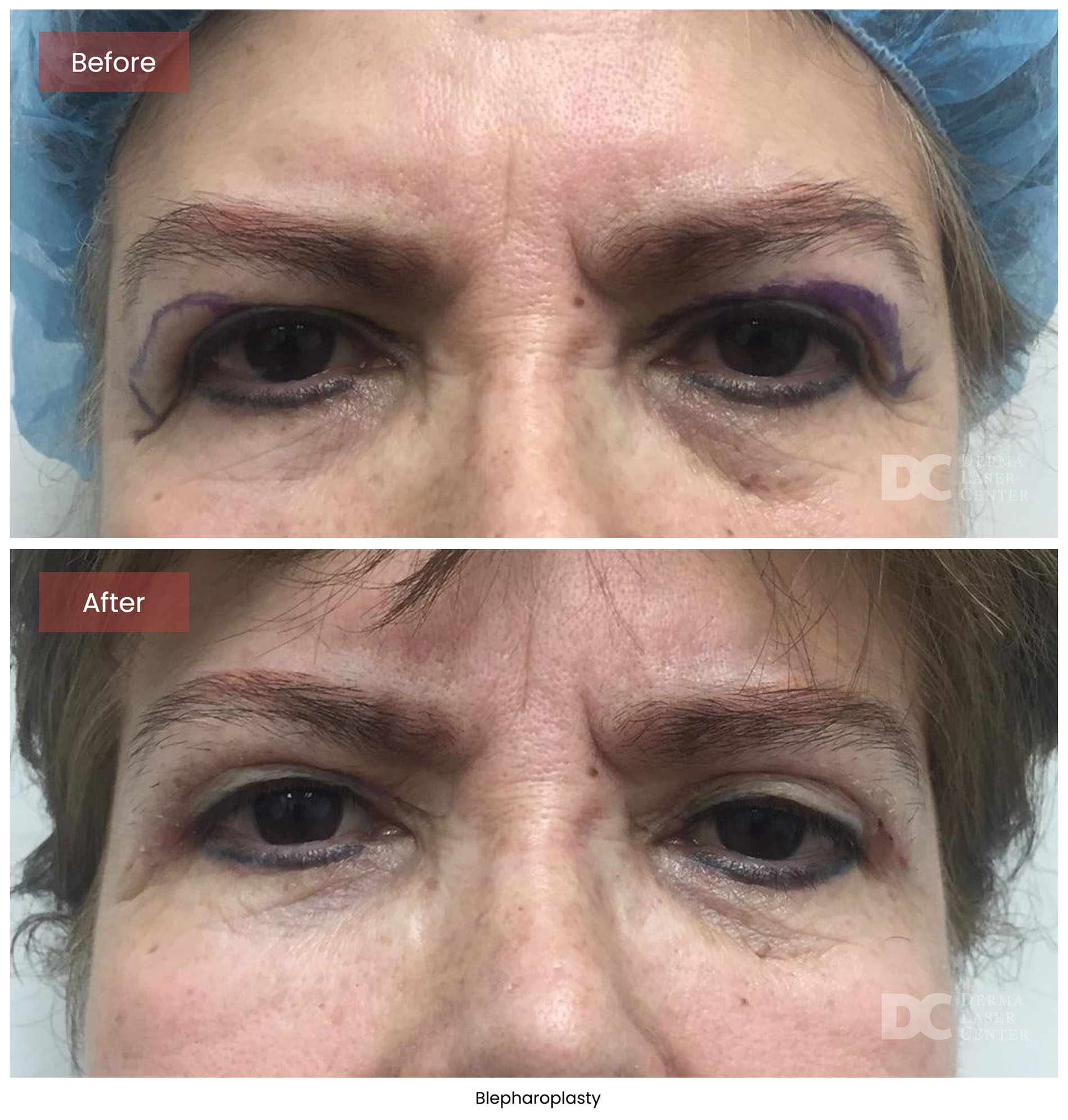 Blepharoplasty 8