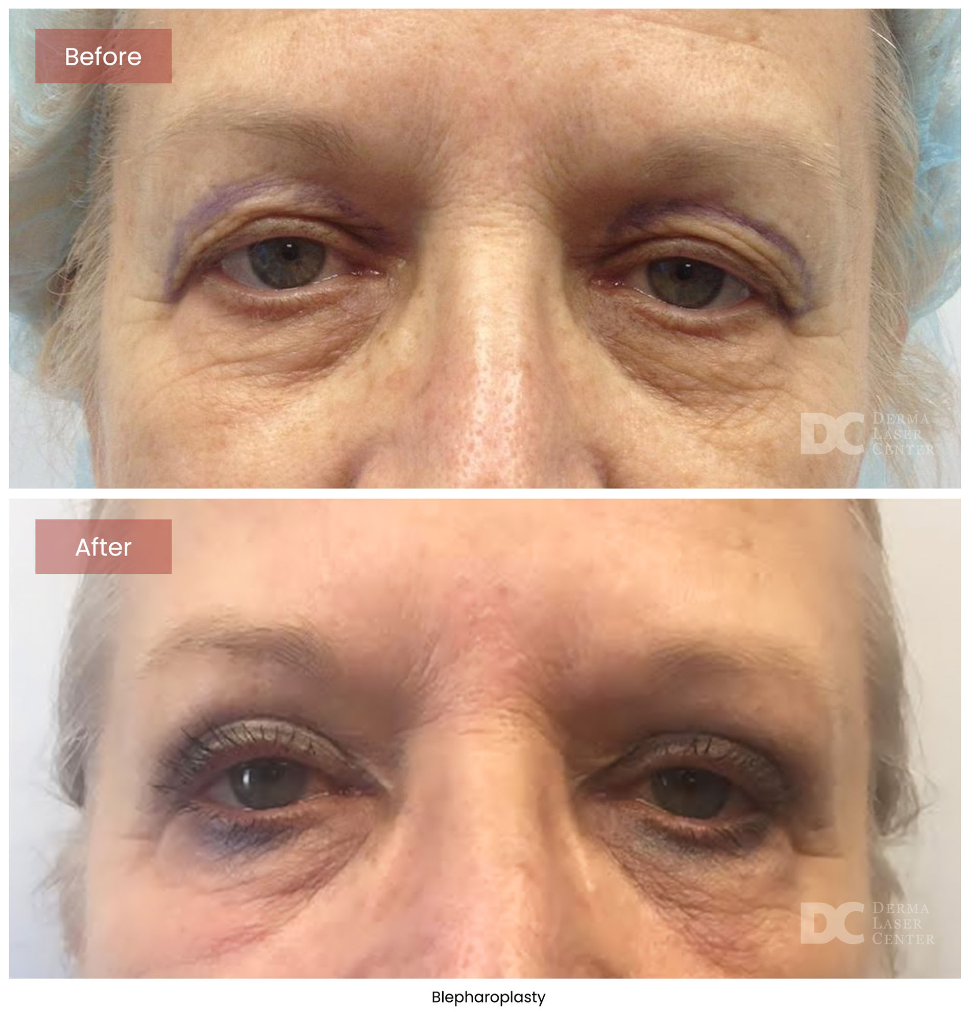 Blepharoplasty 9