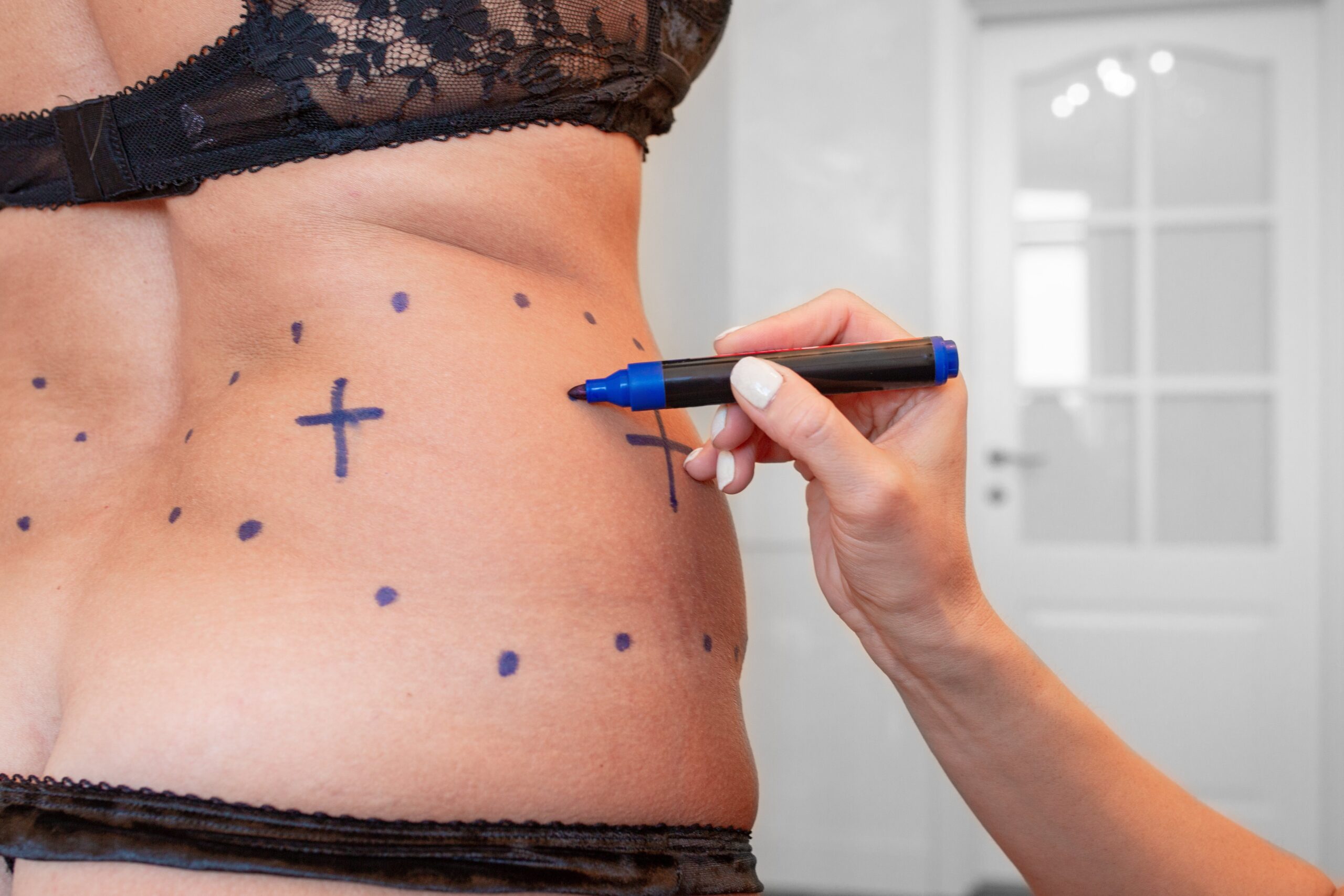 how much fat can 360 liposuction remove