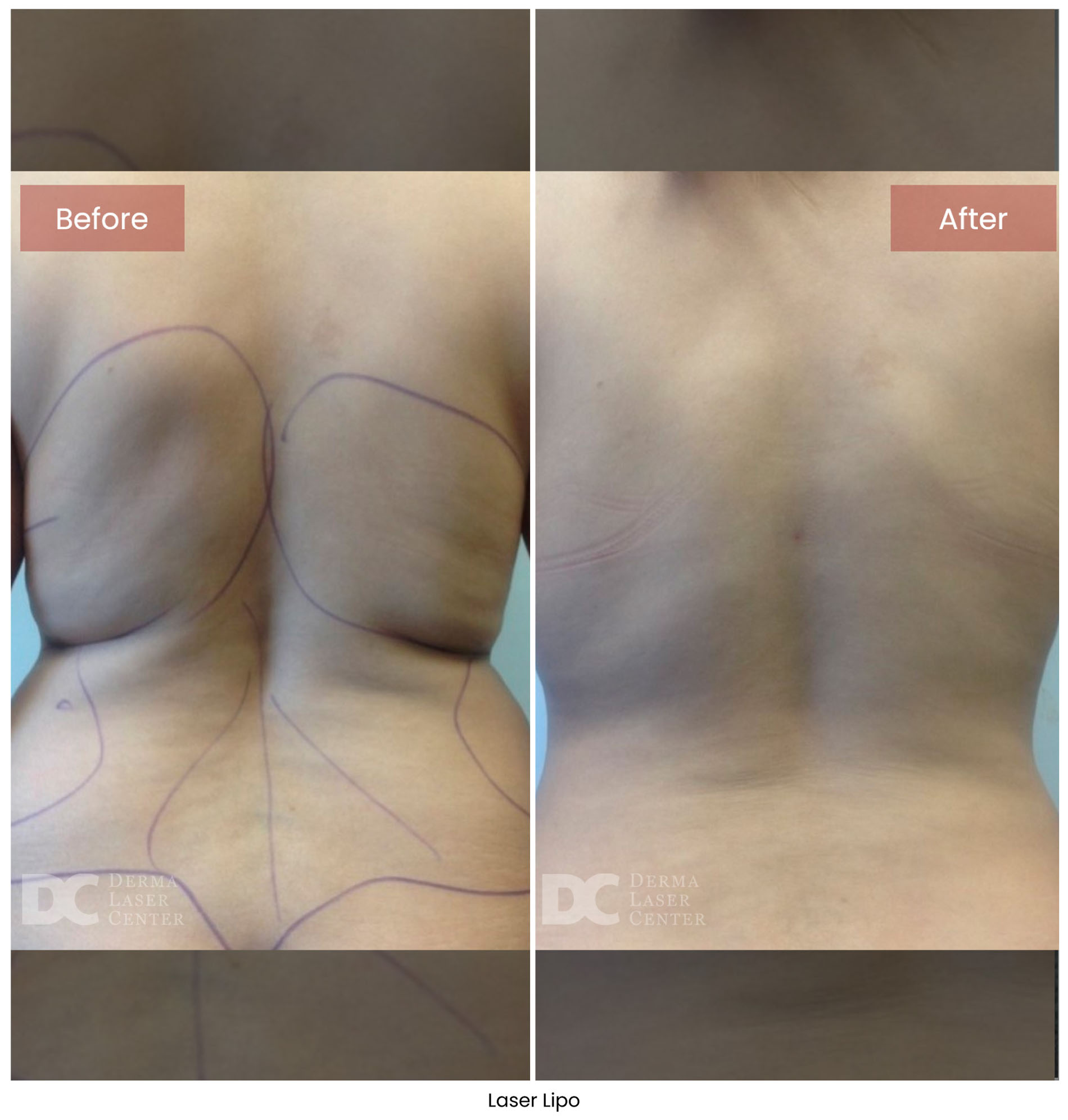 Laser Lipo 1