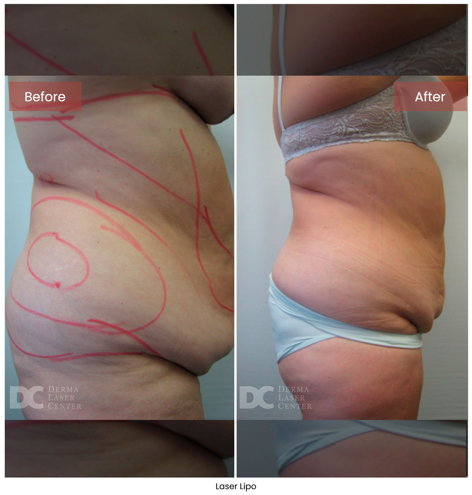 Laser Lipo 10