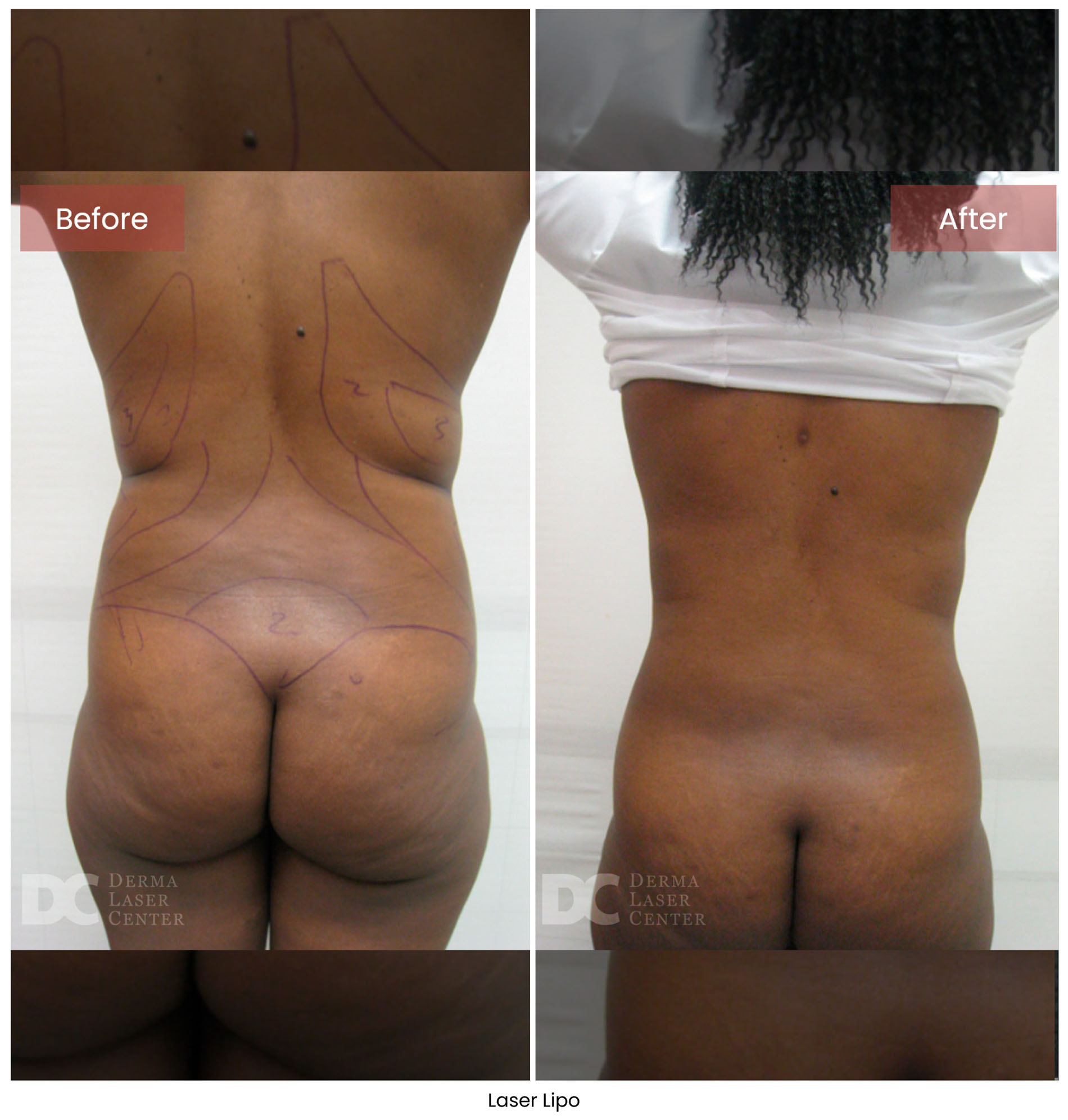 Laser Lipo 11