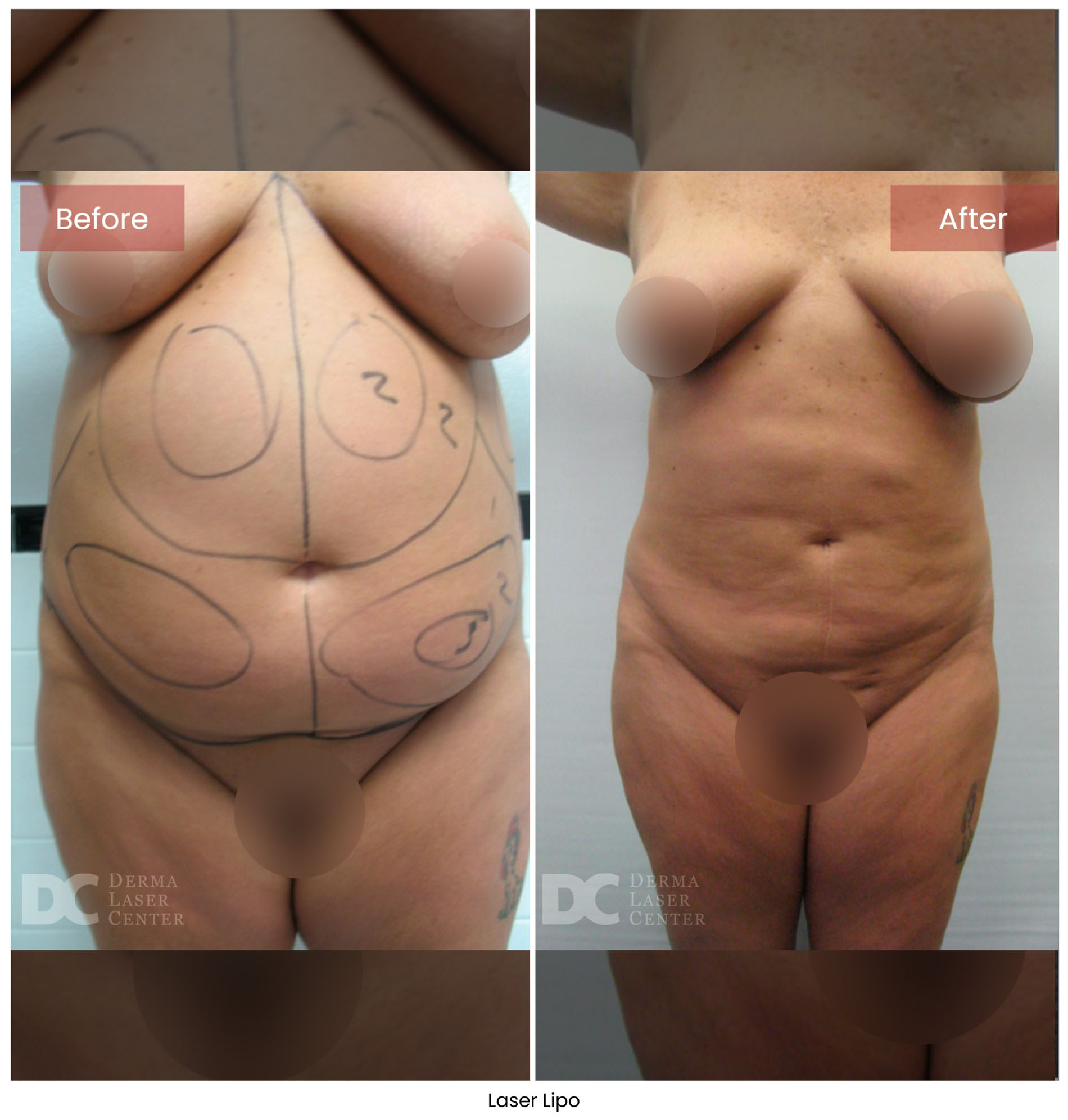 Laser Lipo 12