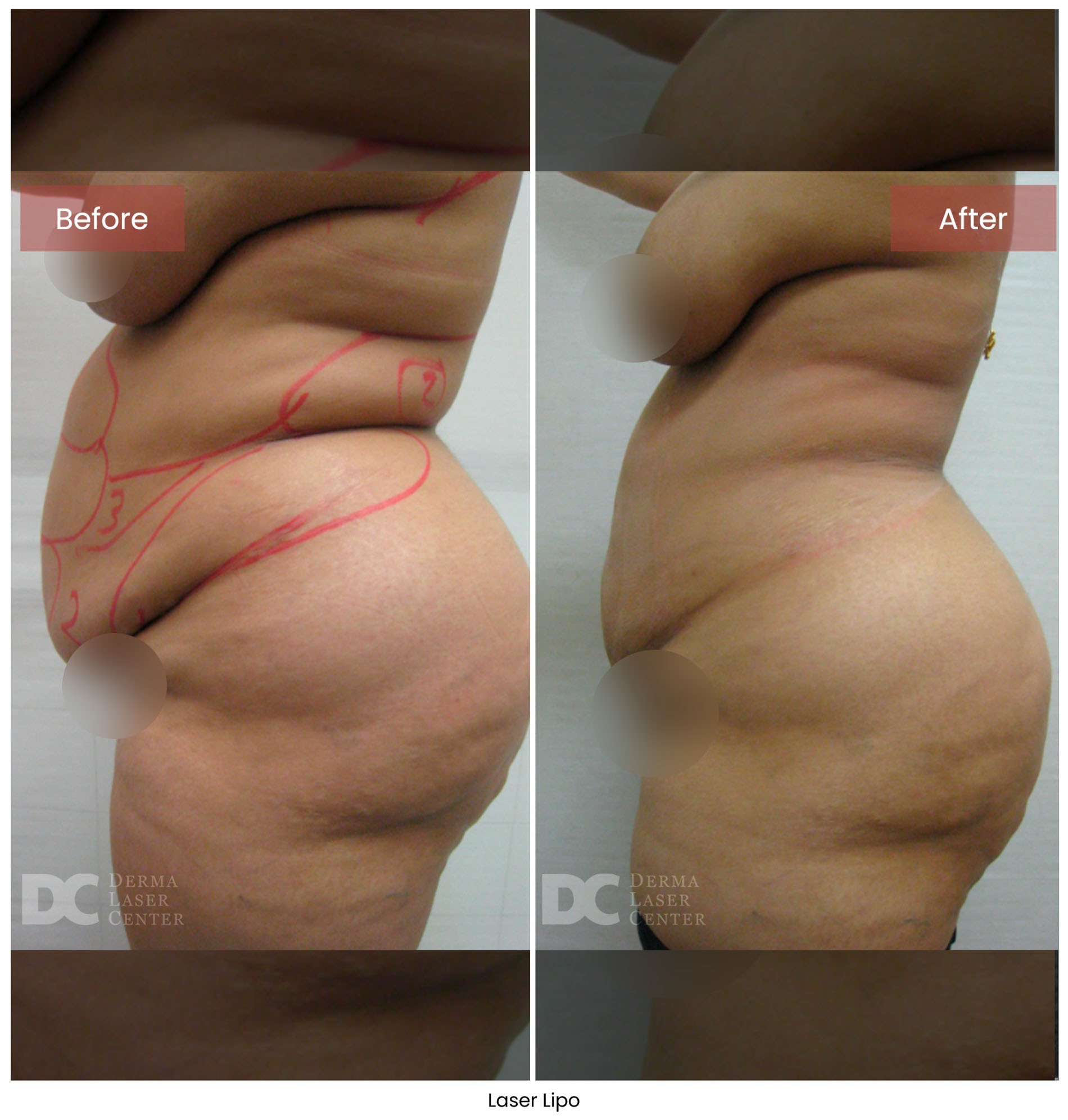 Laser Lipo 13