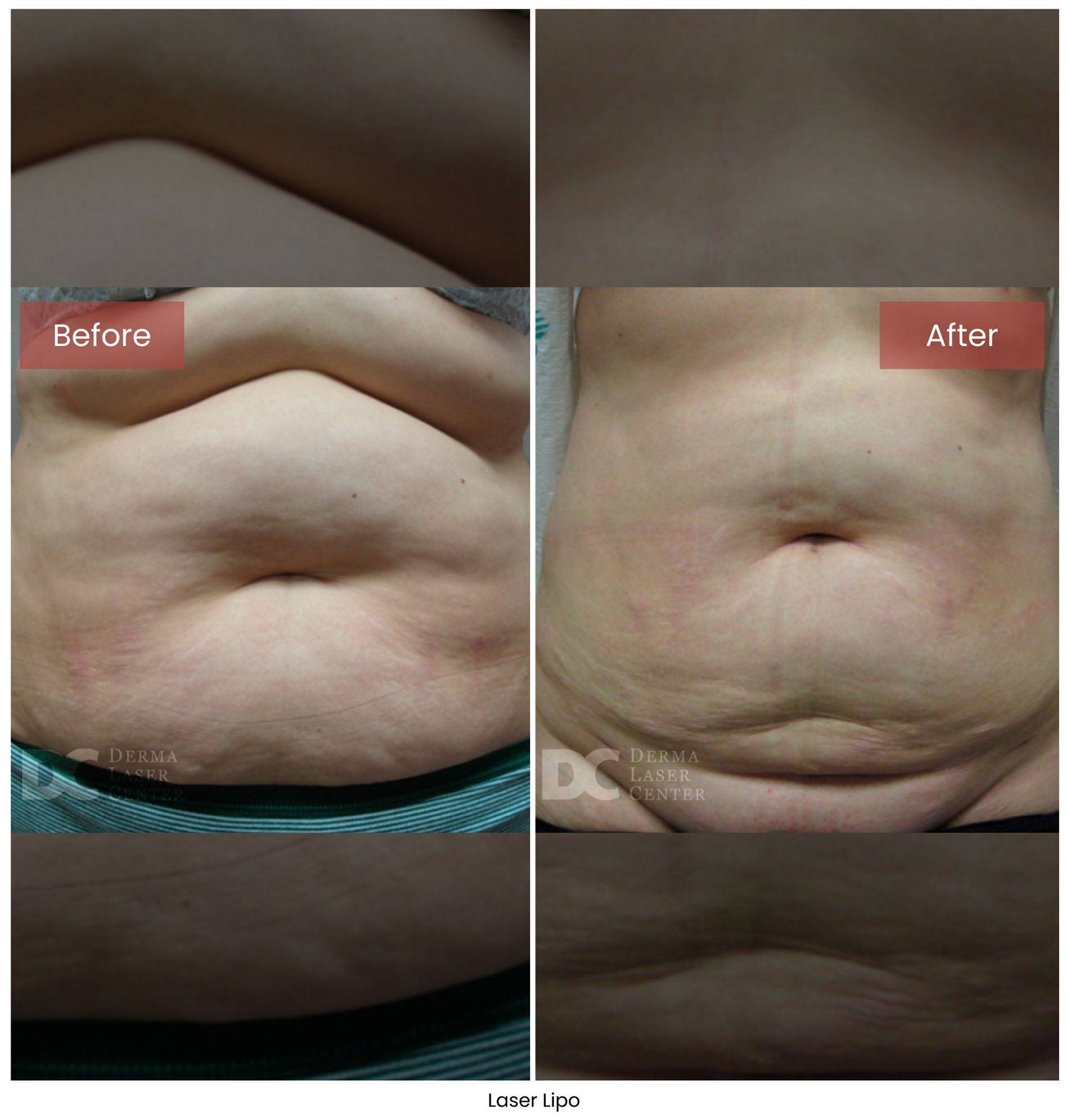Laser Lipo 14
