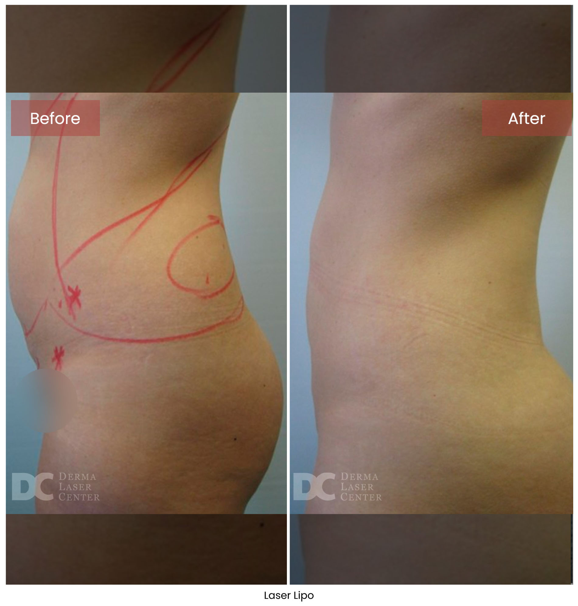 Laser Lipo 2