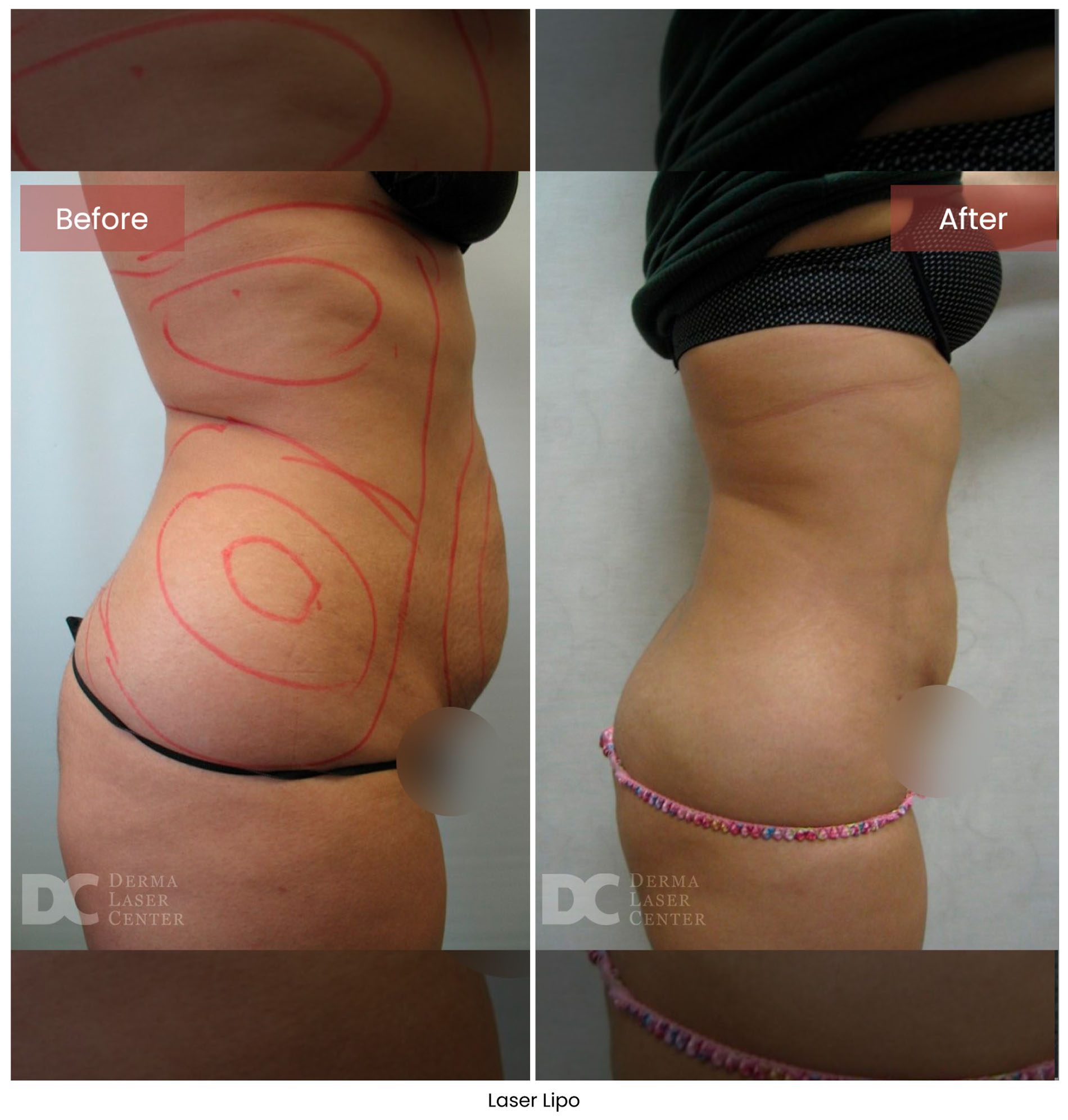 Laser Lipo 3