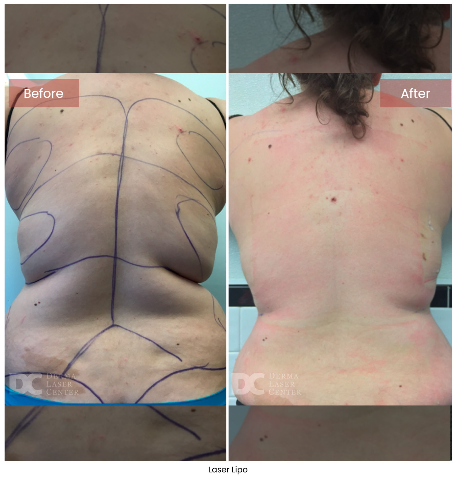Laser Lipo 4