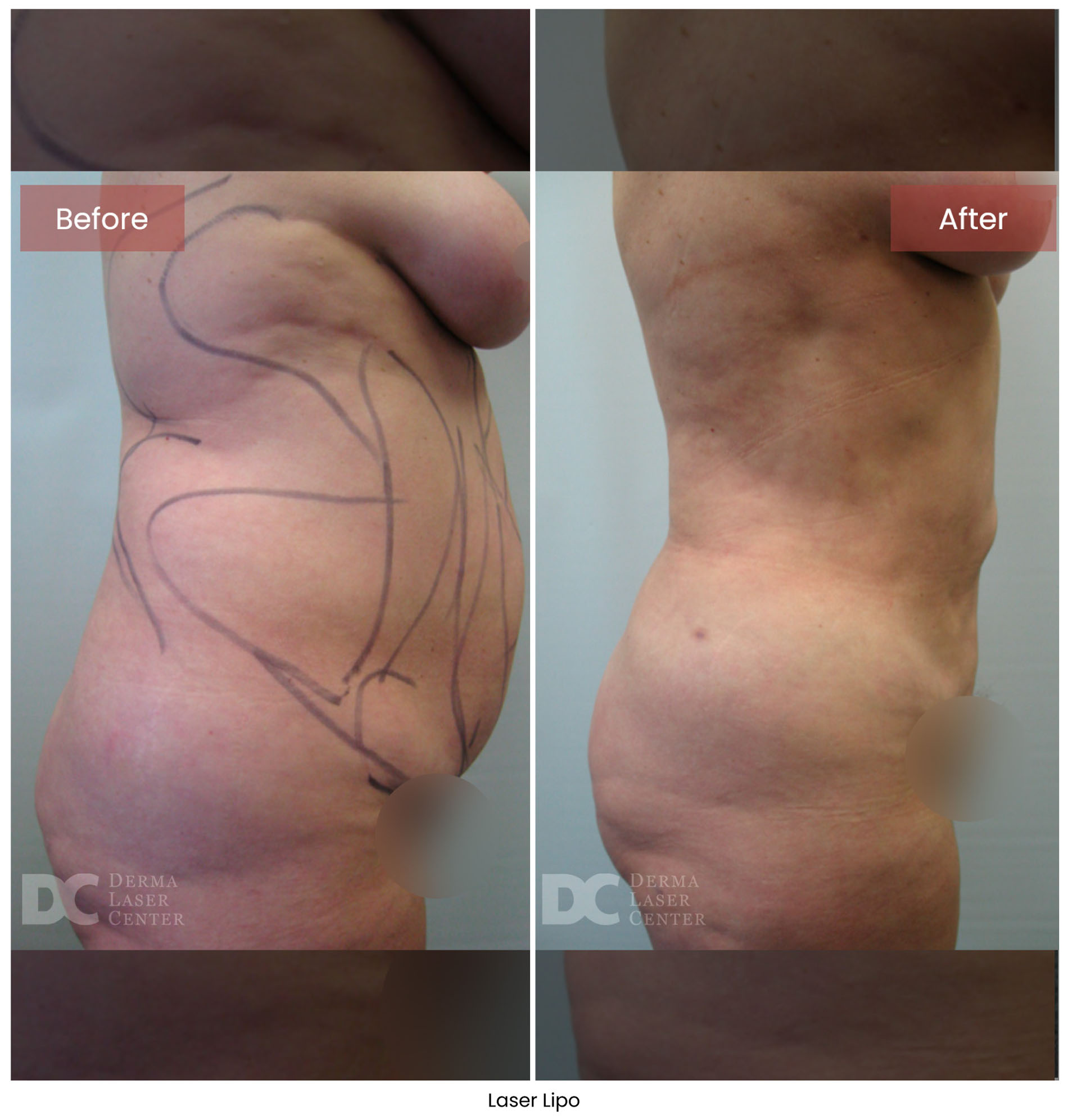 Laser Lipo 5