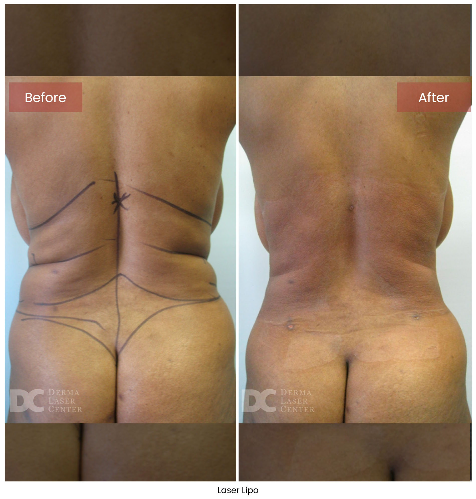 Laser Lipo 6