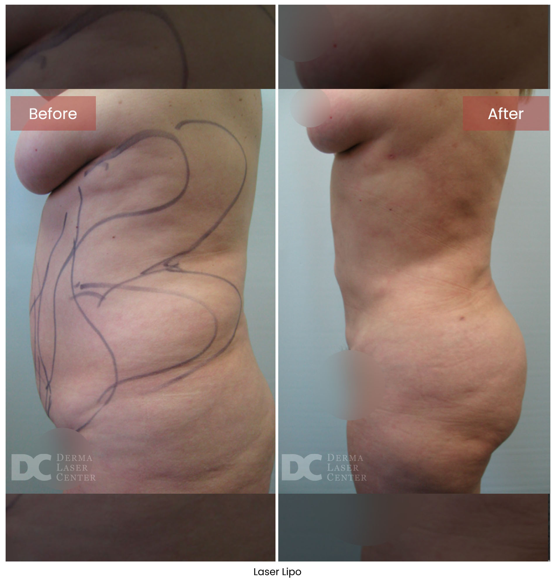 Laser Lipo 7