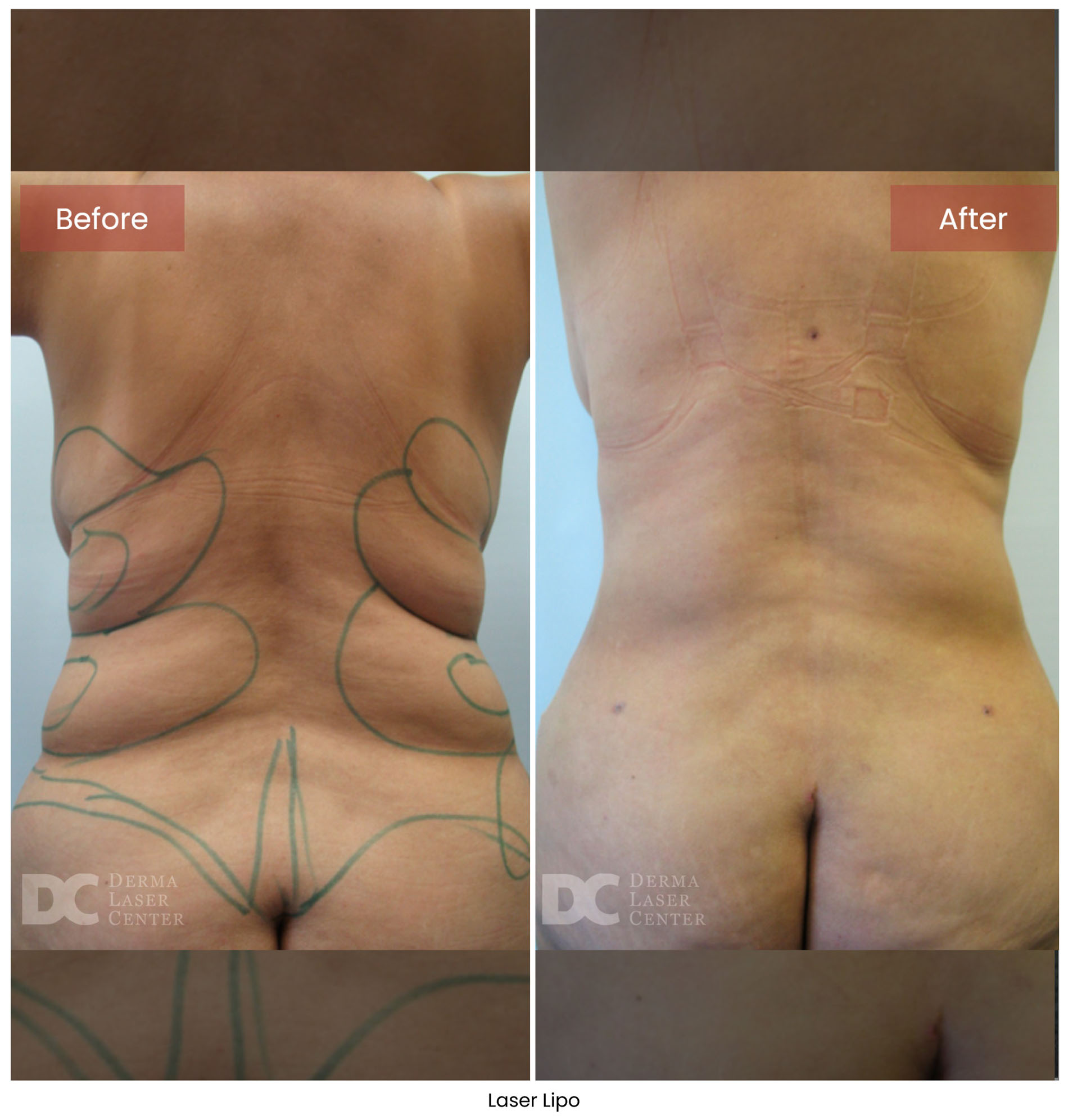 Laser Lipo 8