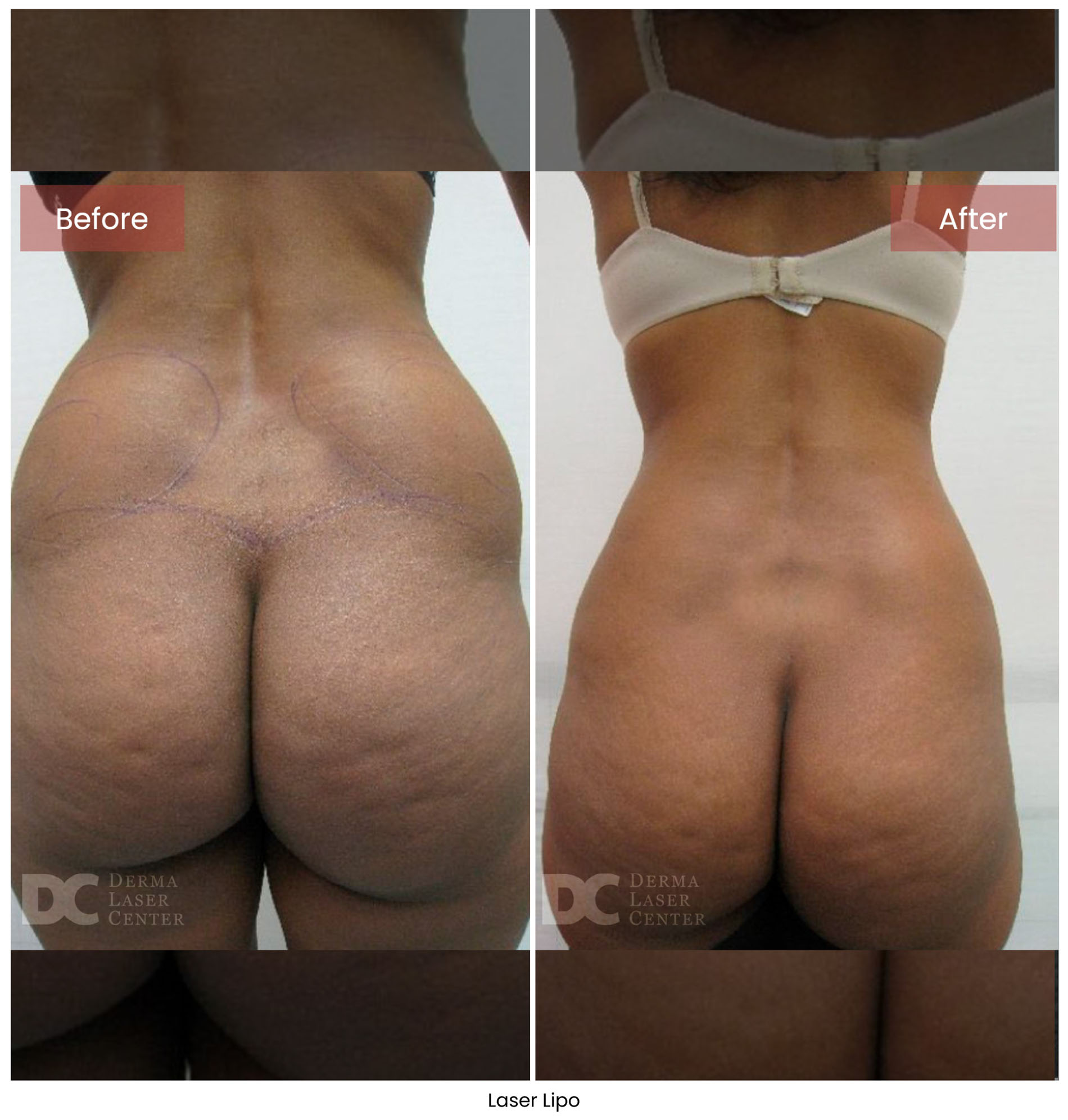 Laser Lipo 9