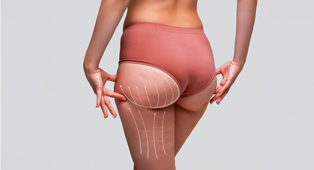 Fat Transfer Pictures