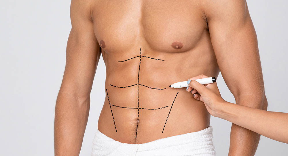 Male Lipo Pictures