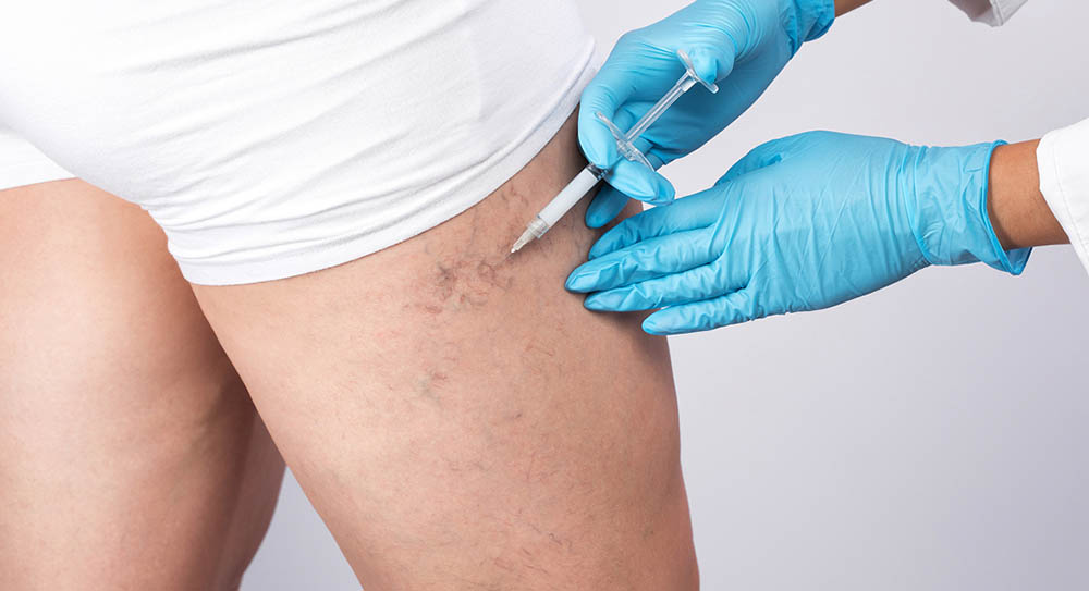 Spider Vein Treatment Pictures