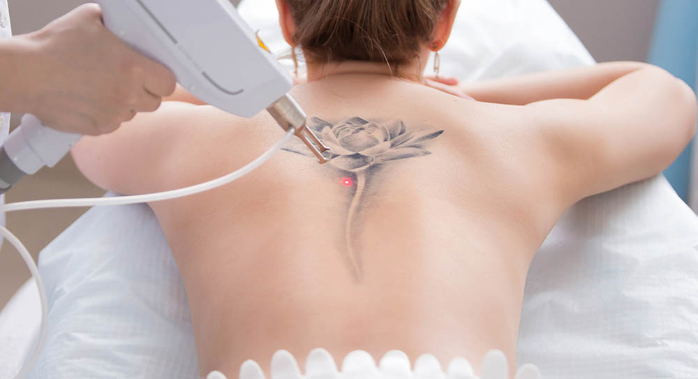 Tattoo Removal Photos
