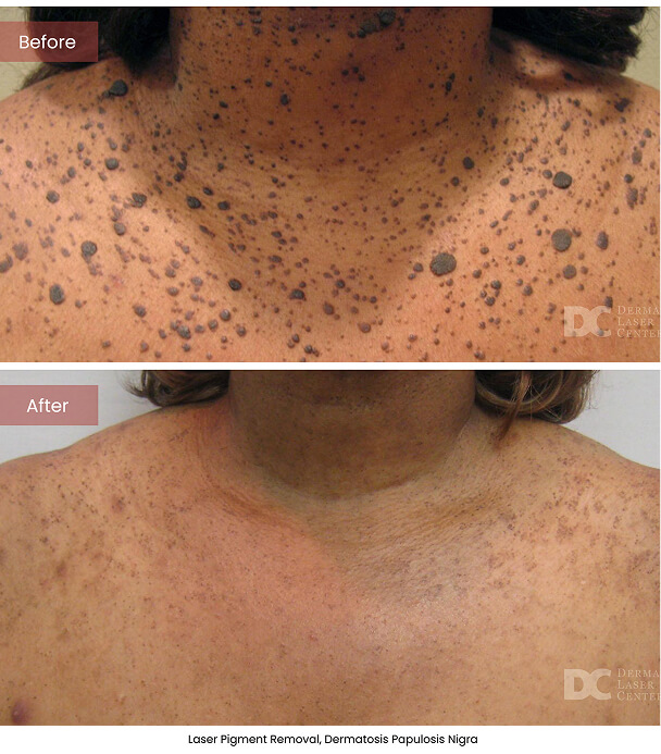 B&A Blepharoplasty Image 01 V1