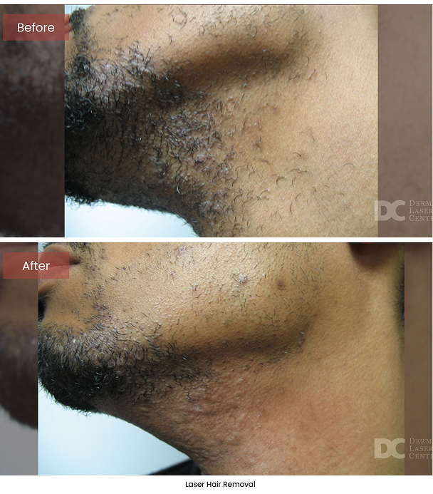 B&A Blepharoplasty Image 01 V1