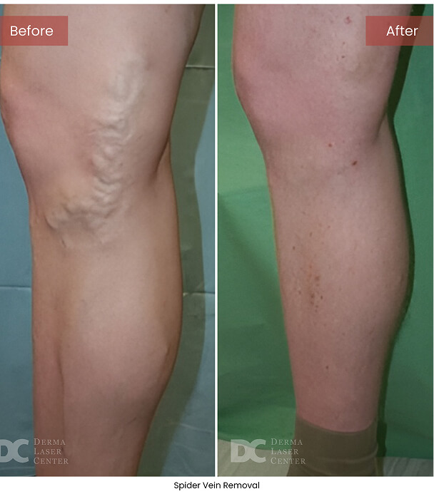 B&A Blepharoplasty Image 01 V1