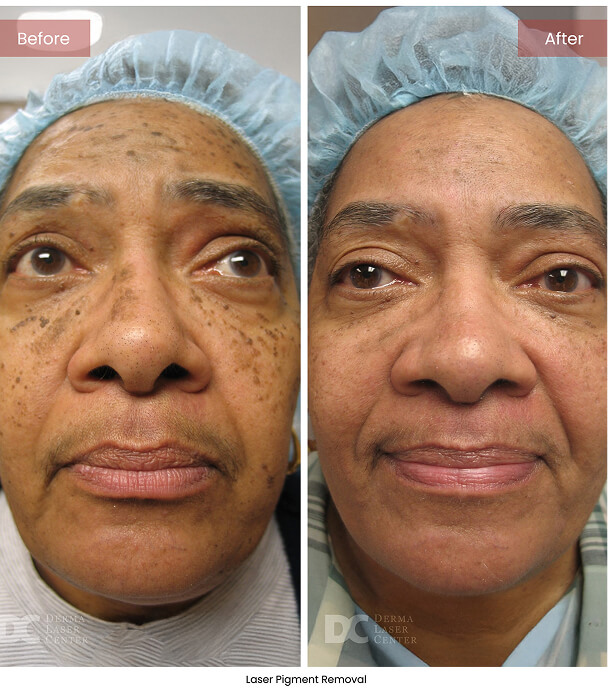 B&A Blepharoplasty Image 02 V1 1
