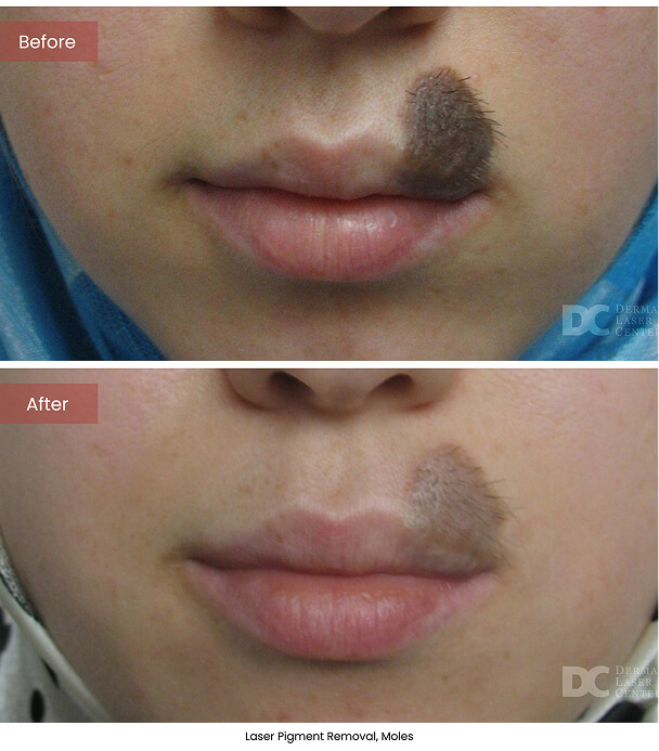 B&A Blepharoplasty Image 02 V1 3