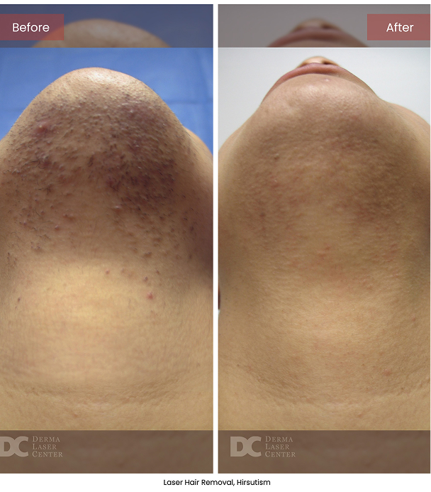 B&A Blepharoplasty Image 02 V1