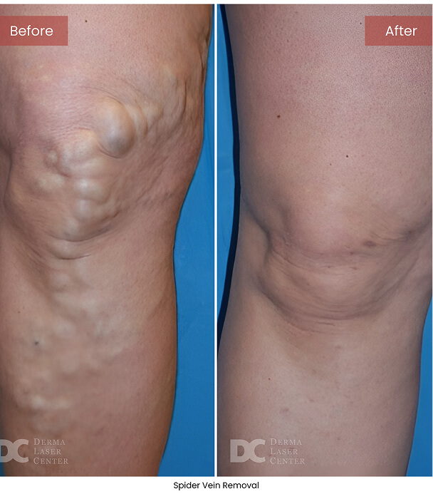 B&A Blepharoplasty Image 02 V1