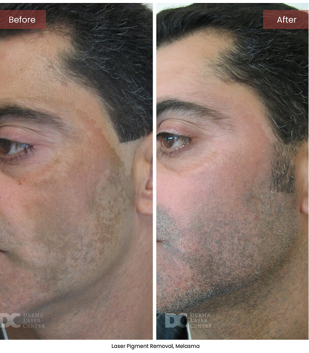 B&A Blepharoplasty Image 03 V1 1
