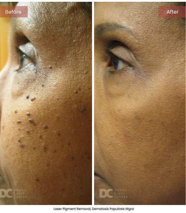 B&A Blepharoplasty Image 03 V1