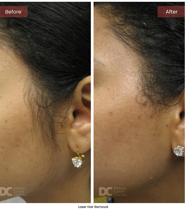 B&A Blepharoplasty Image 03 V1