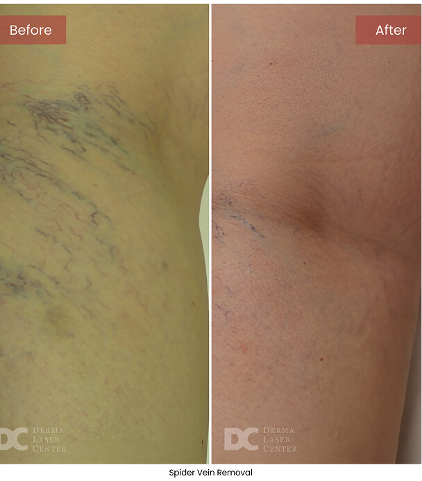 B&A Blepharoplasty Image 03 V1