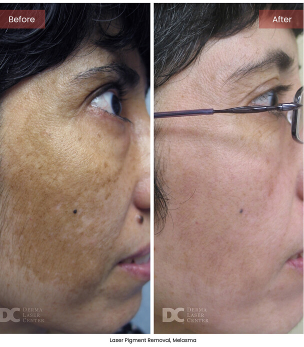 B&A Blepharoplasty Image 04 V1 1
