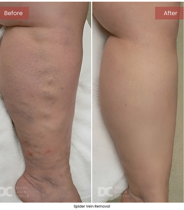 B&A Blepharoplasty Image 04 V1