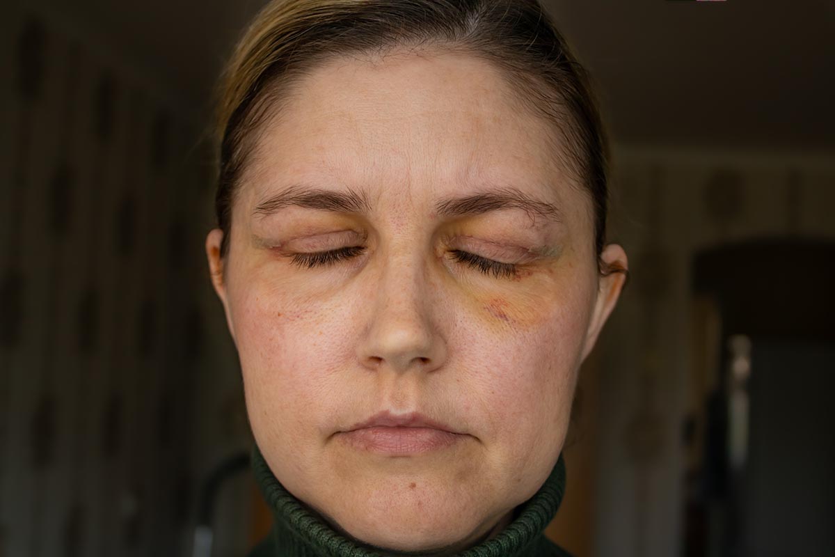 Lower Blepharoplasty Healing