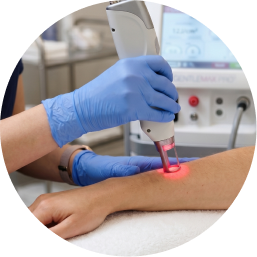 Custom Laser Hair Removal Treatments