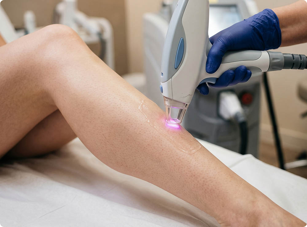 full body laser hair removal cost