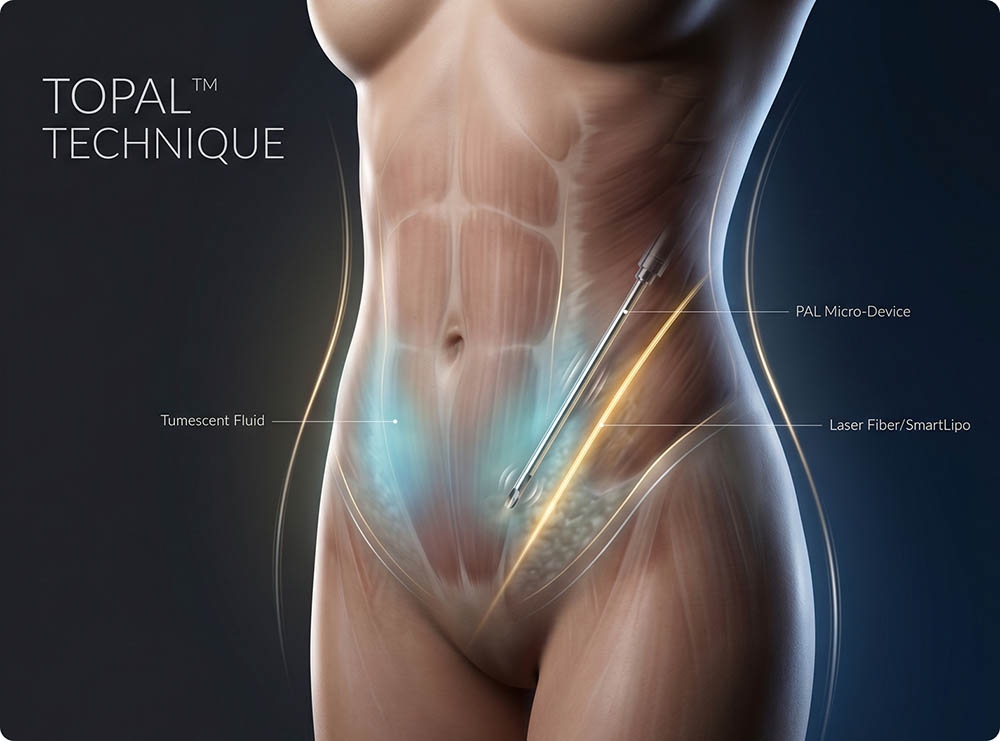 SmartLipo Clinic New Jersey