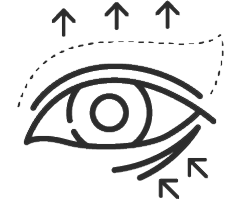 Combined Upper and Lower Blepharoplasty