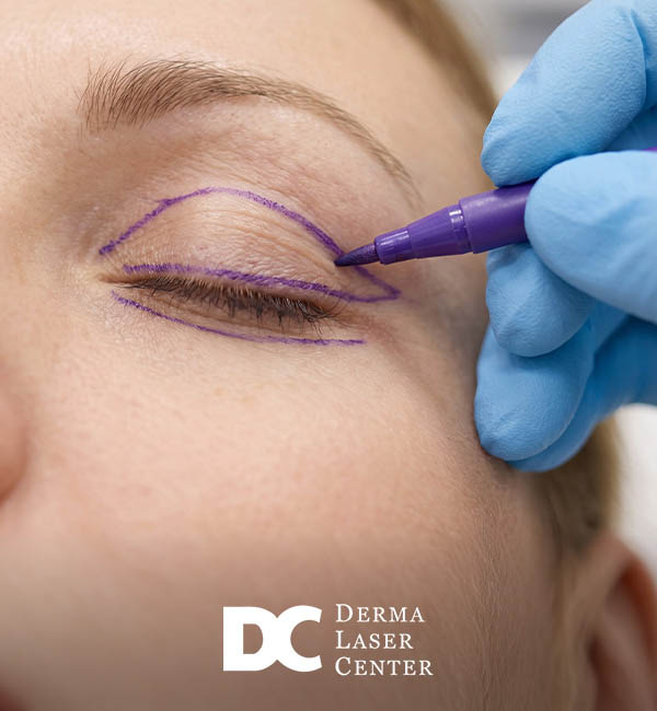 Does Insurance Cover Blepharoplasty