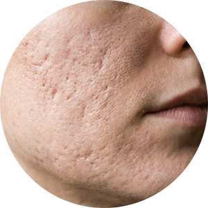 Acne Scars and Other Scarring