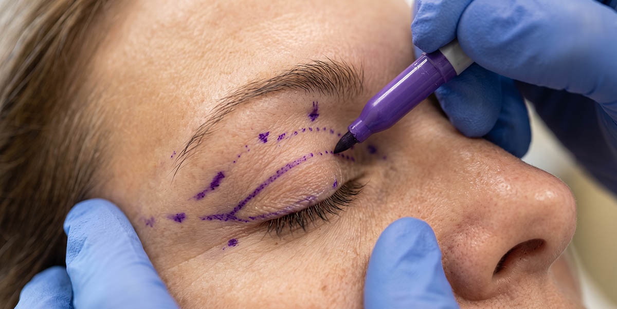 Blepharoplasty for Women