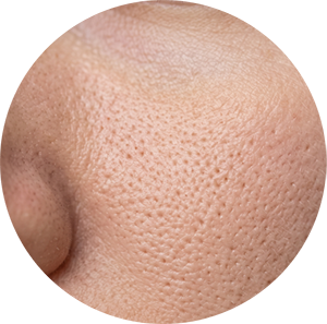 Enlarged Pores